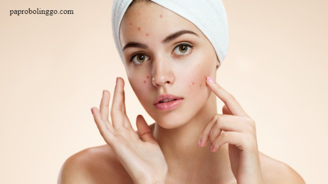 Produk Skincare yang Mengandung Salicylic Acid